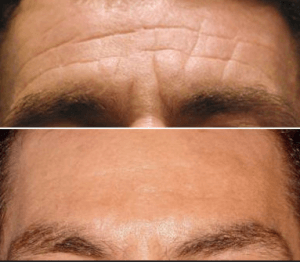 botox Miami results before and after