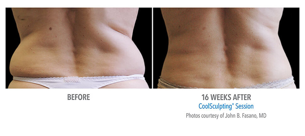 CoolSculpting before after pictures