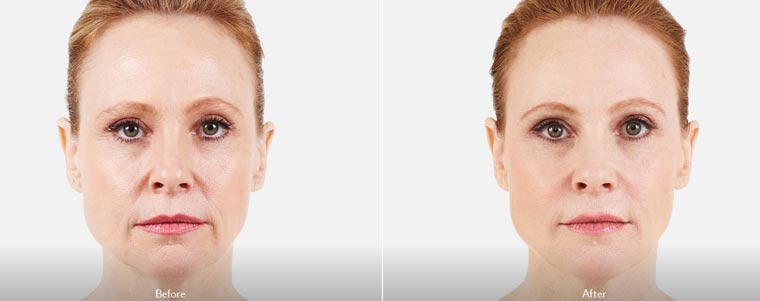 dermal fillers before and after | Miami - Aventura