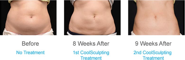 fat reduction before after coolsculpting aventura