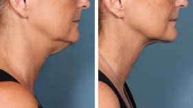 Double Chin Removal with Kybella