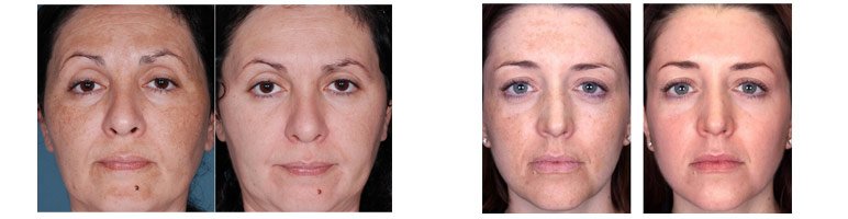 chamical-peels-before-after