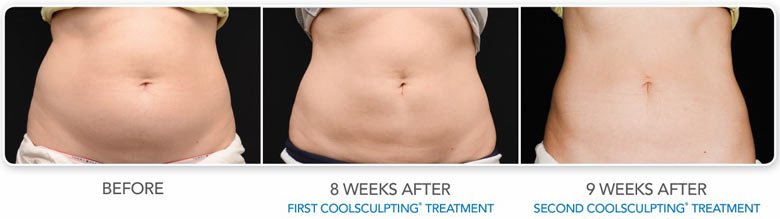 coolsculpting fat reduction results