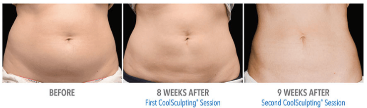 miami coolsculpting results before after