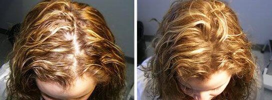 hair loss treatment for women aventura
