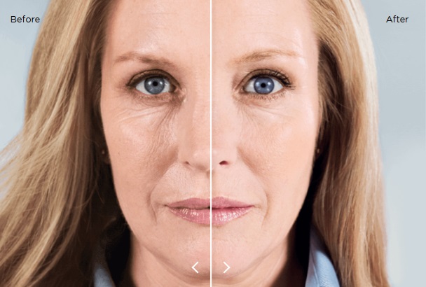 Before and after sculptra