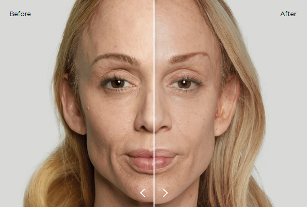 Before and after sculptra