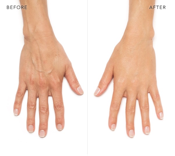 BEFORE AND AFTER HANDS RADIESSE