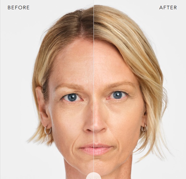 BEFORE AND AFTER RADIESSE 1