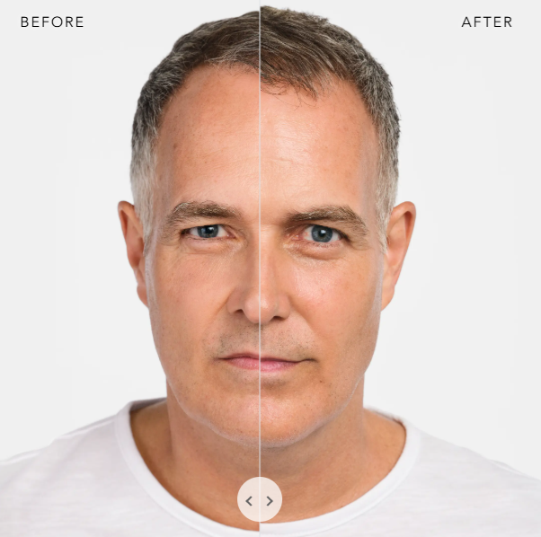 BEFORE AND AFTER RADIESSE 2