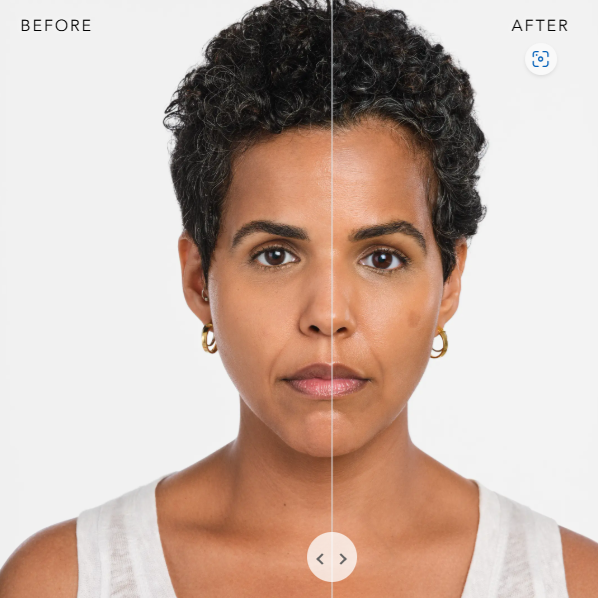 BEFORE AND AFTER RADIESSE 3