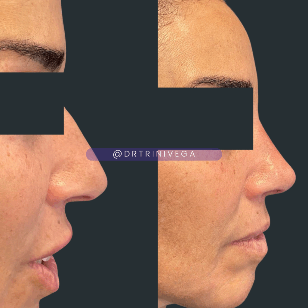 Copy of Filler Nosejob (2)