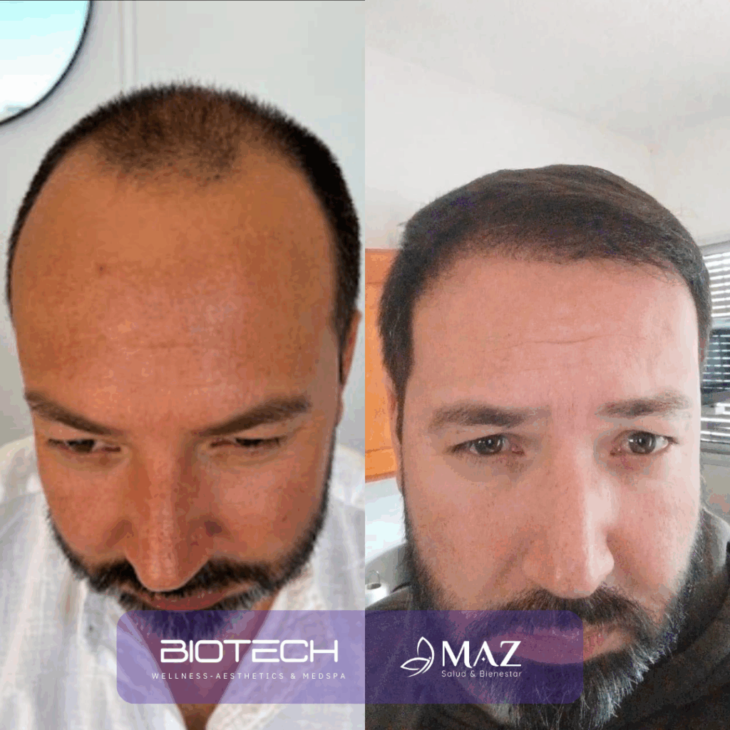 Copy of Hair Transplant