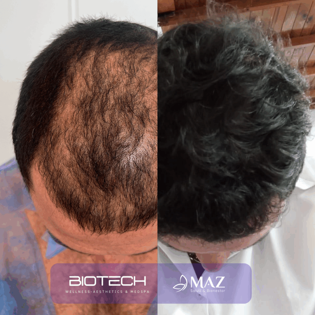 Copy of Hair Transplant (2)