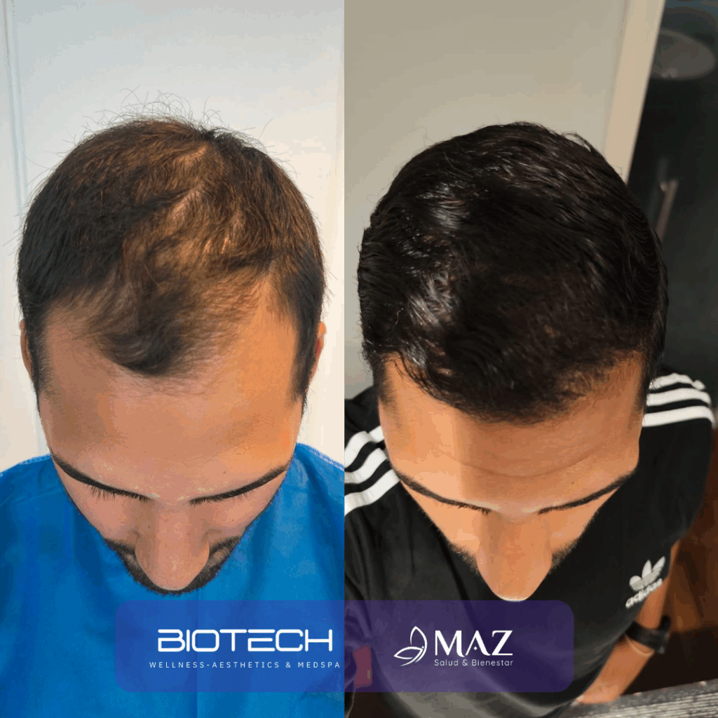 Copy of Hair Transplant (4)