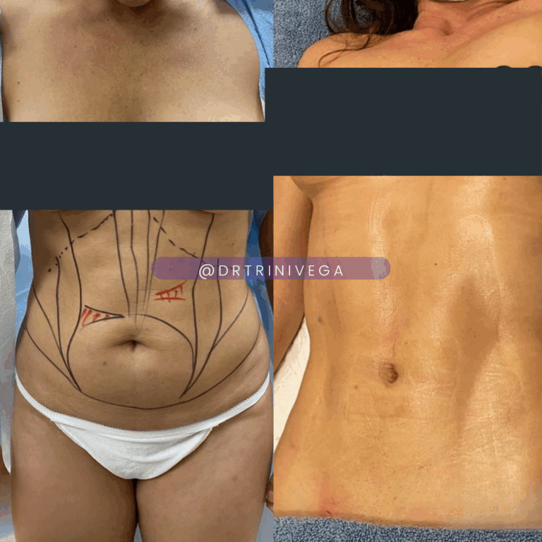 Copy of LIPO 360- HD