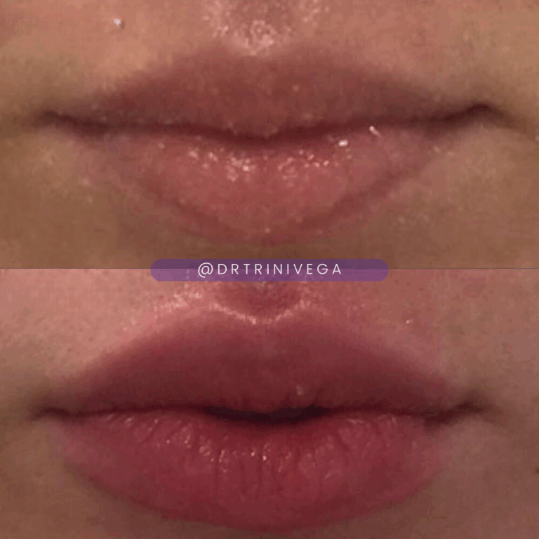 Copy of Lip filler (2)
