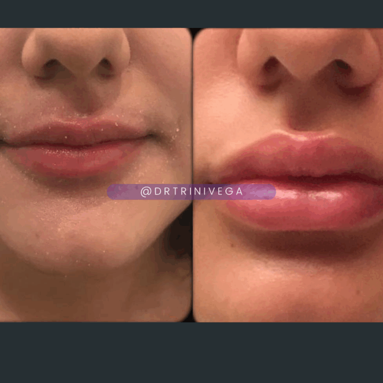 Copy of Lip filler (3)