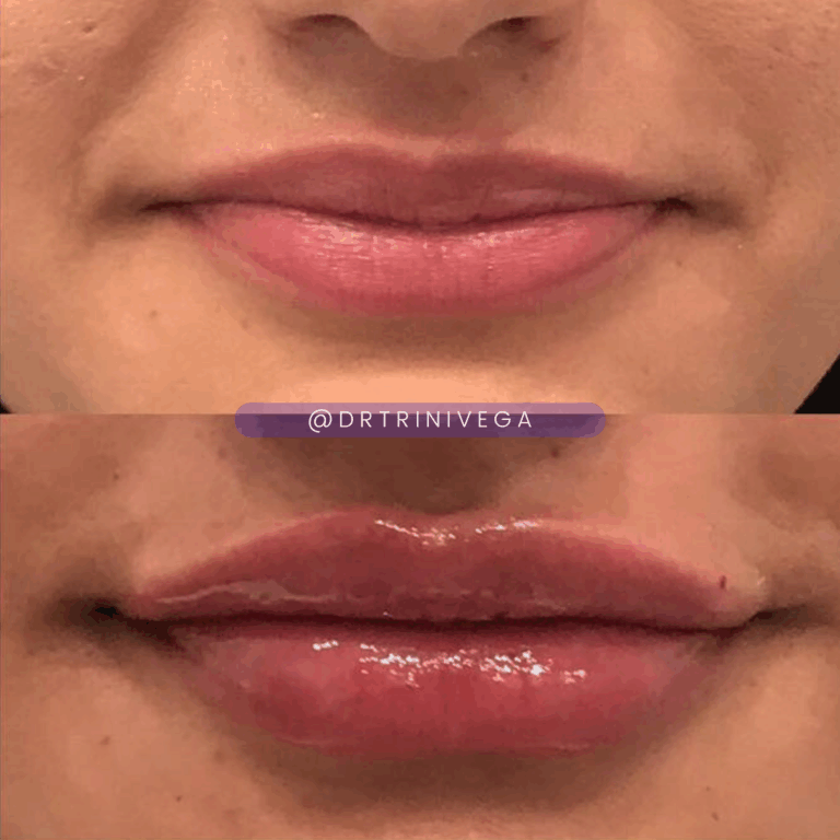Copy of Lip filler (4)