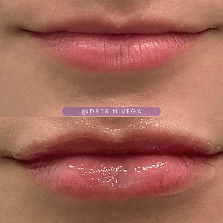 Copy of Lip filler (5)