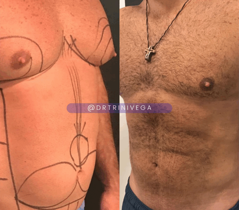 Copy of Lipo 360 HD (3)