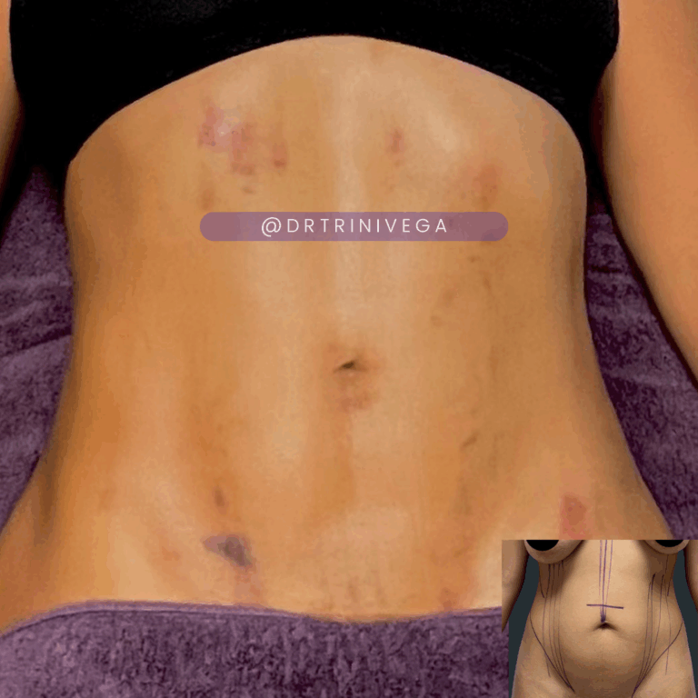 Copy of Lipo 360-HD (4)