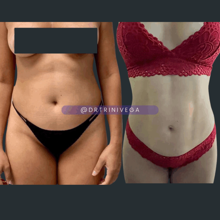 Copy of Lipo 360 HD (8)