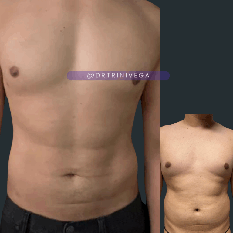 Copy of Lipo HD 360