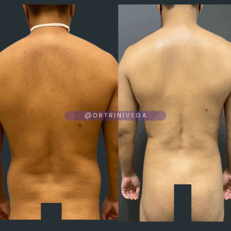 Copy of Liposuction 360 (2)