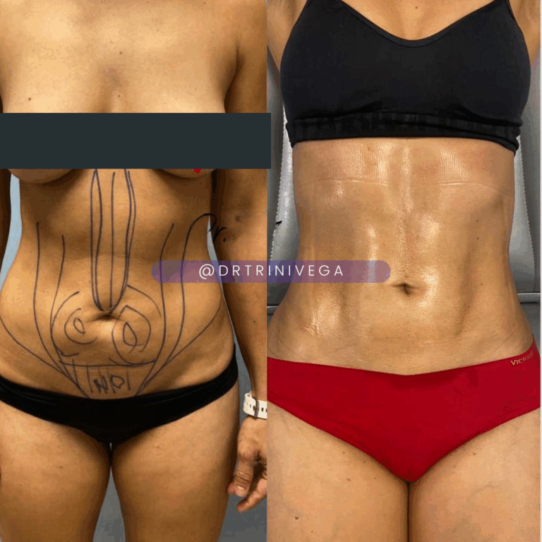 Copy of Liposuction 360 HD