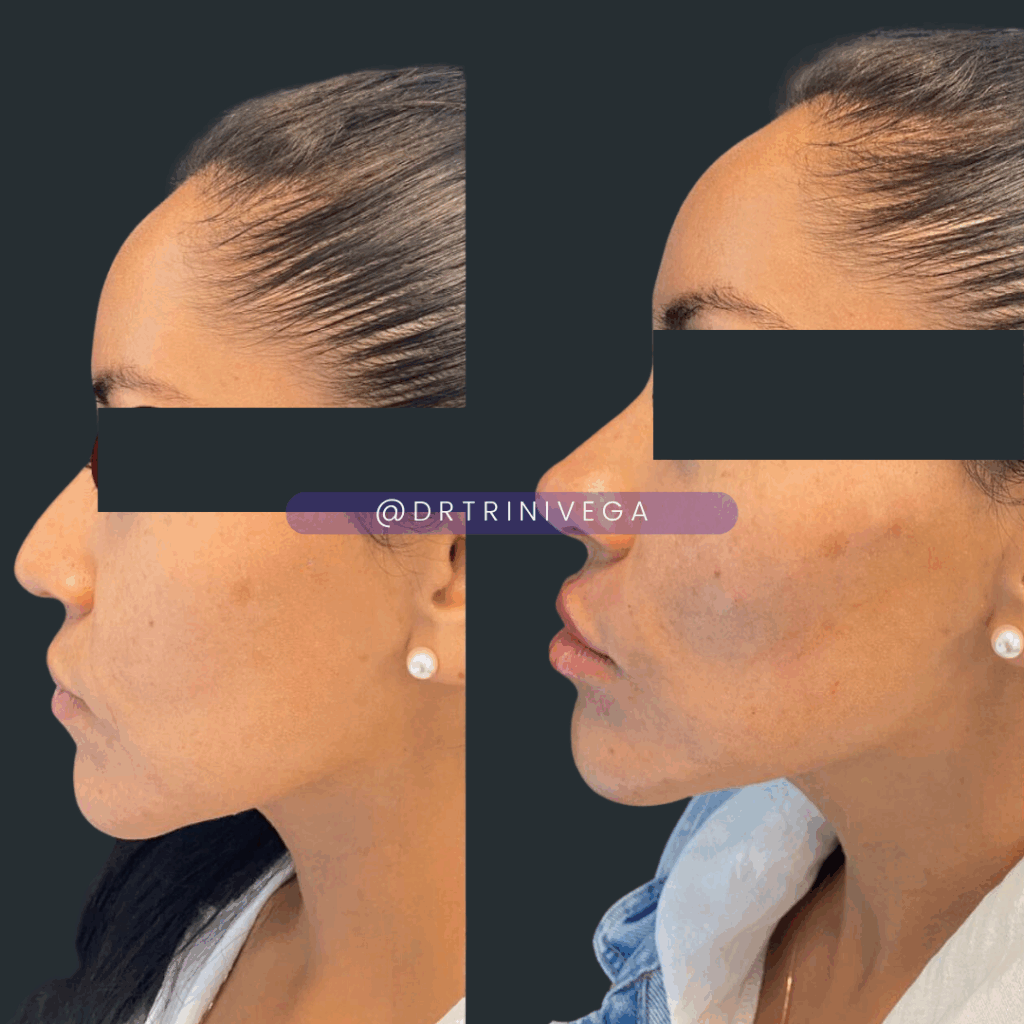 Copy of filler chin