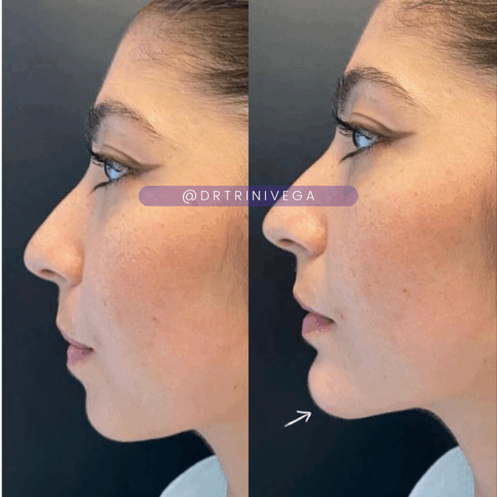 Copy of fillers chin (1)