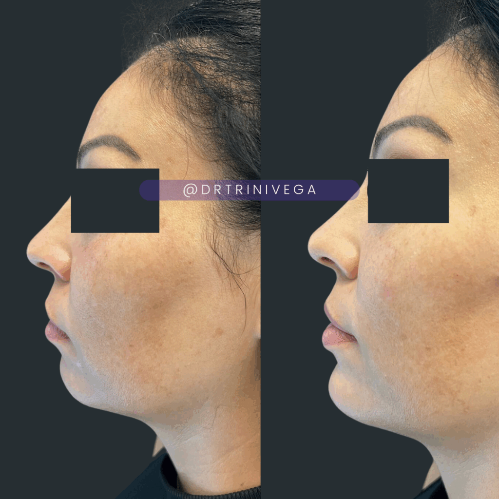 Copy of fillers chin (2)