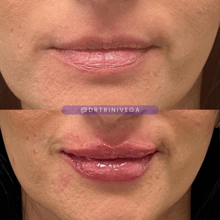 Copy of fillers lips