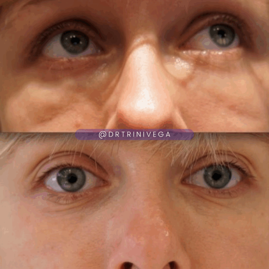 Copy of fillers under eye bags (3)