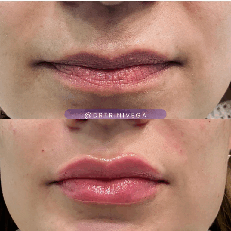 Copy of lip filler nasolabial fold filler
