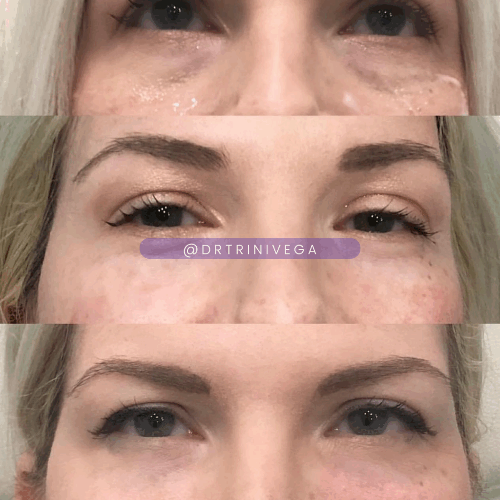 Under eye bag filler