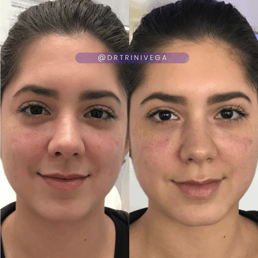 Under eye bag filler (2)