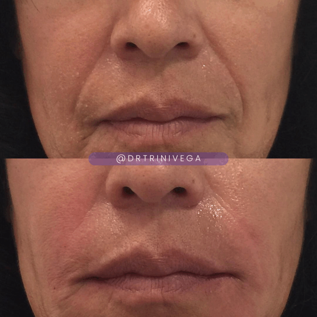 nasolabial fold filler