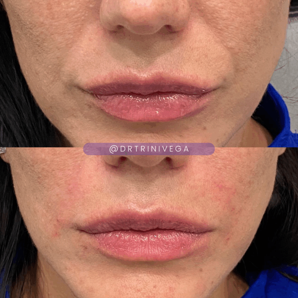 nasolabial fold filler (2)