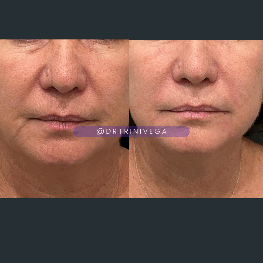 nasolabial folds filler