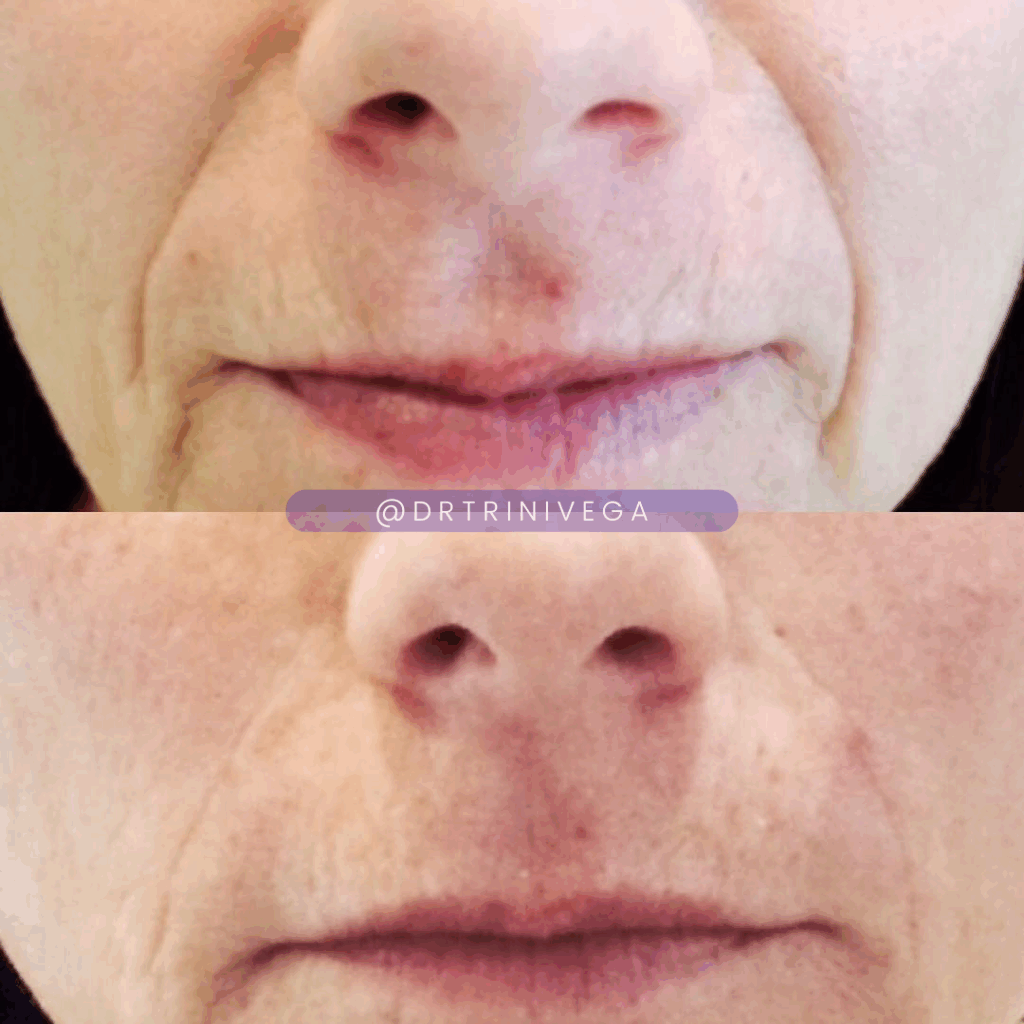 nasolabial folds filler (2)