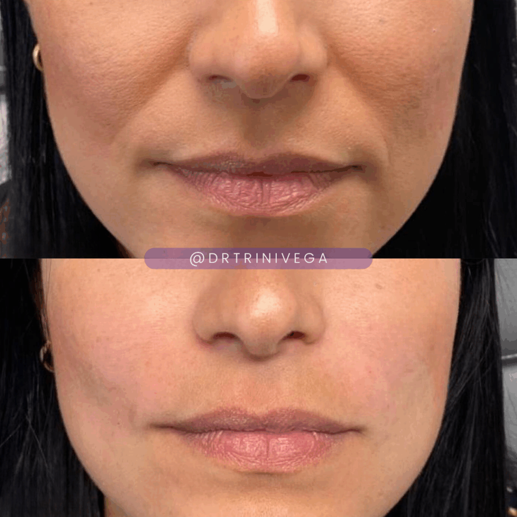 nasolabial folds filler (3)