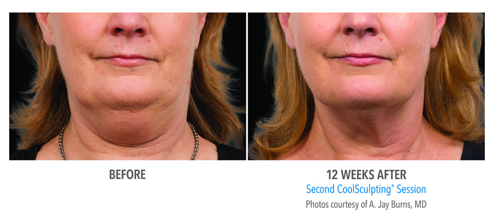 results of double chin removal North Miami FL