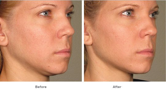 remove double chin