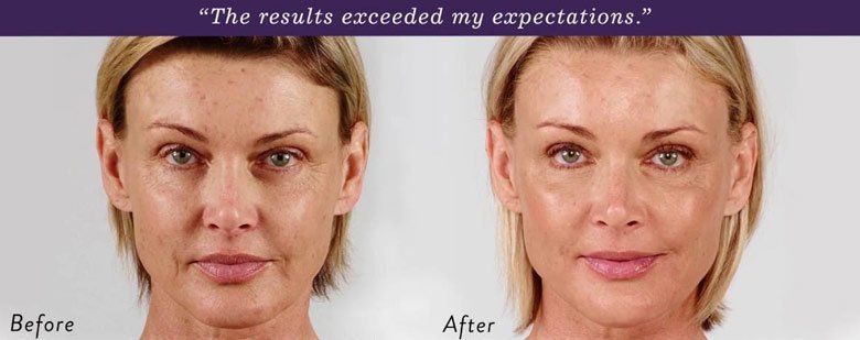 dermal-fillers-results-aventura