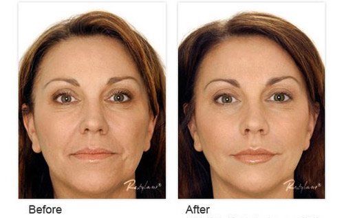 Restylane