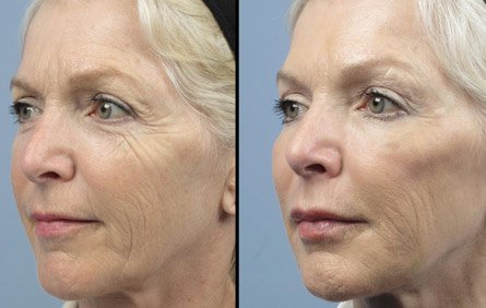 aventura botox treatment