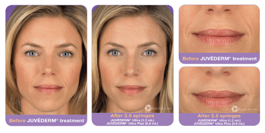 results of juvederm filler Miami fl