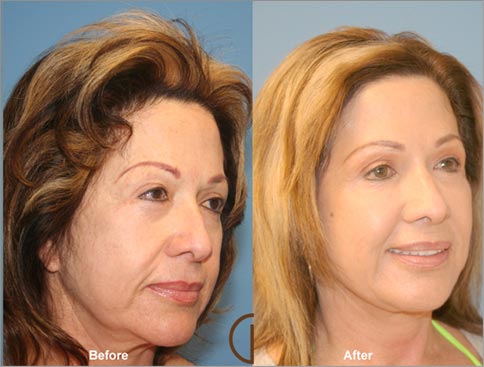 Facial Fat Transfer